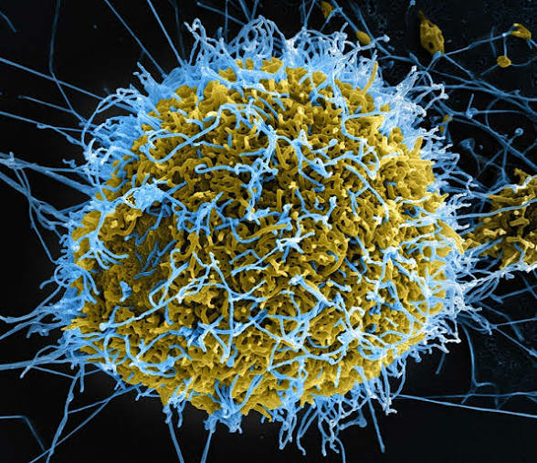 Ebola Patient Develops Multiple Organ Failure As Condition Worsens – NCDC